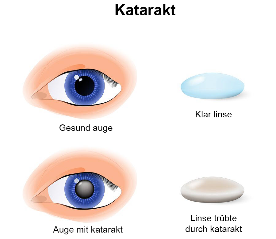 Haupt-Katarakt-Symptome für „Monat der Katarakt“