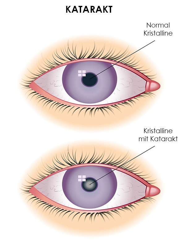What is an Intraocular Lens? Why is it used for Cataracts?