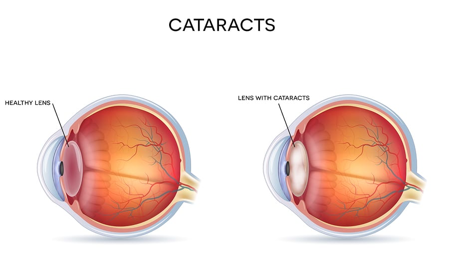 What Causes Cataracts and How to Prevent Them