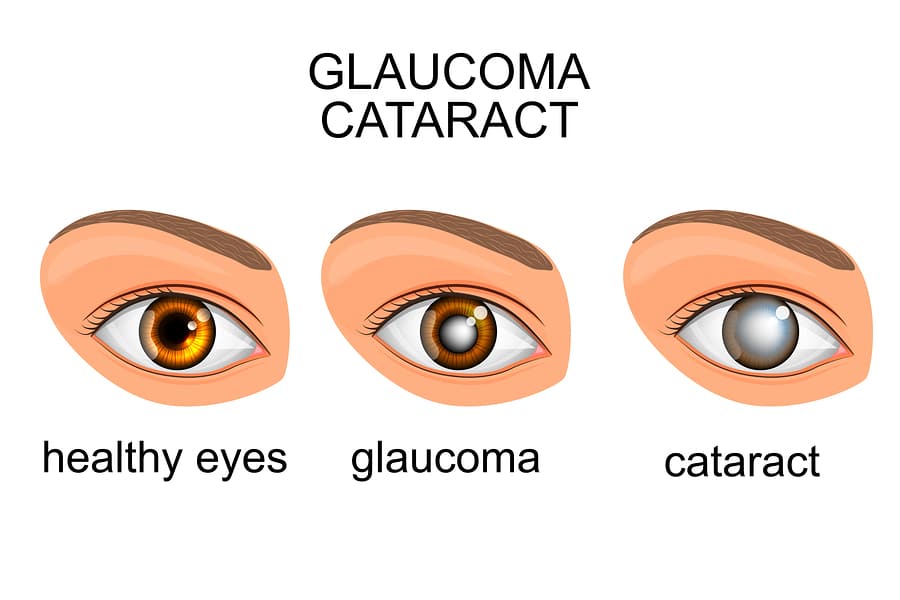 Can I Have Cataract Surgery if I Have Glaucoma?
