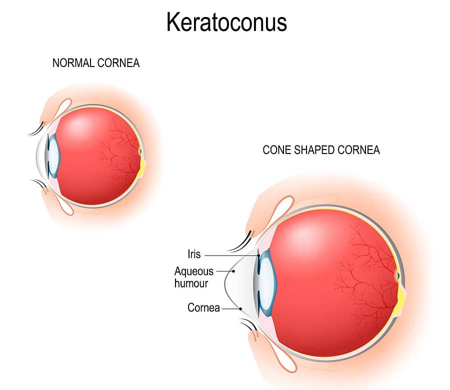How Does a Complex Cornea from Keratoconus Affect Cataract Surgery?