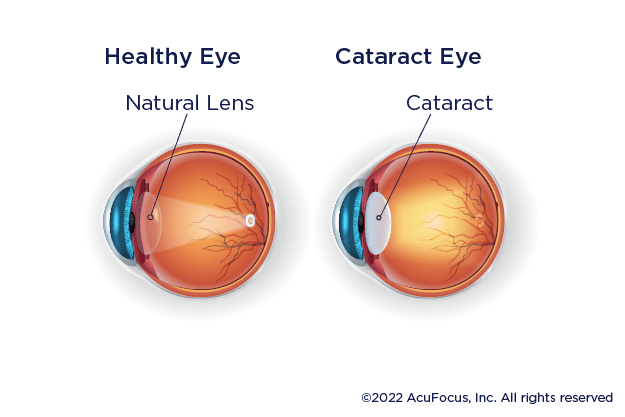 How People with Cataracts Process Light